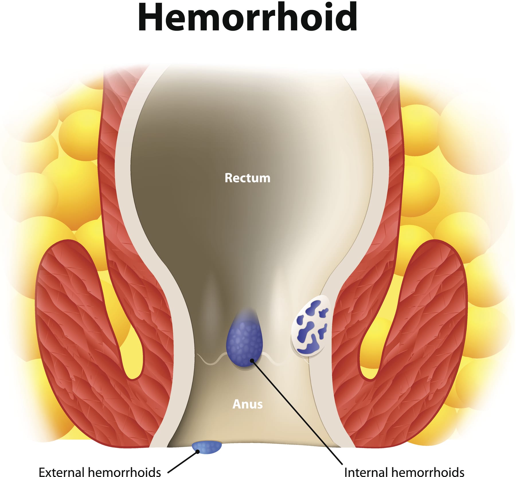 Internal Hemorrhoids