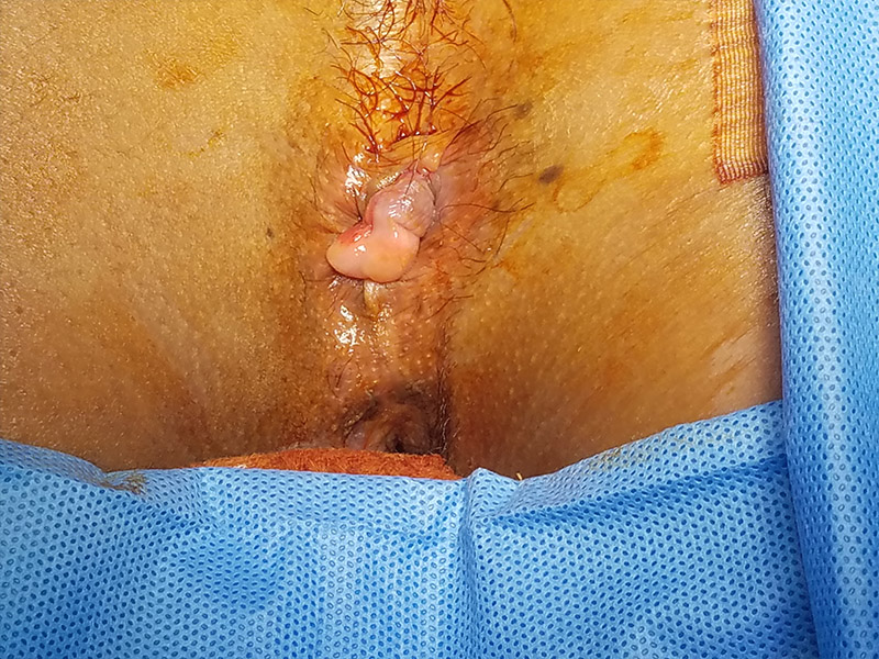 Anal Rejuvenation Before by Dr. Zuri Murrel